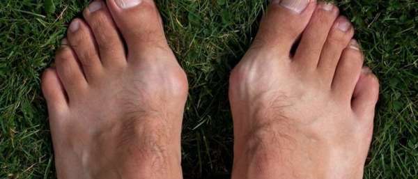 Нарост на суставе пальца ноги